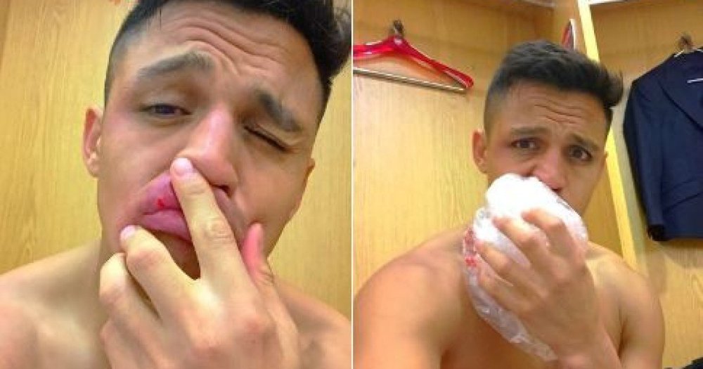 alexis-sanchez-injury.thumb.jpg.80ff684905d9e3804d285f3a83facd27.jpg